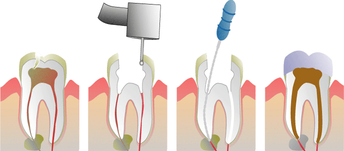 root-canals